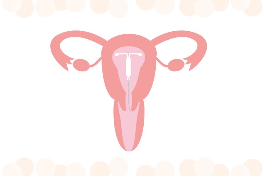 spirala kontracepcija