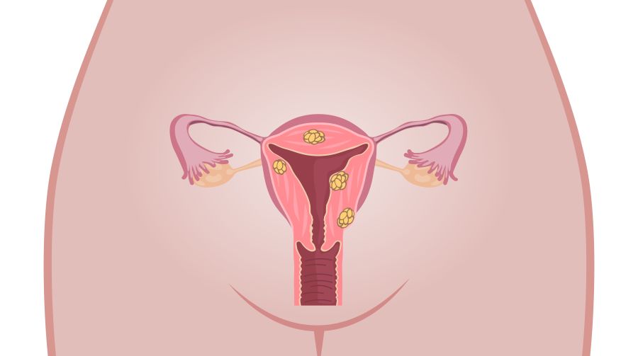 miomi maternice, liječenje, simptomi