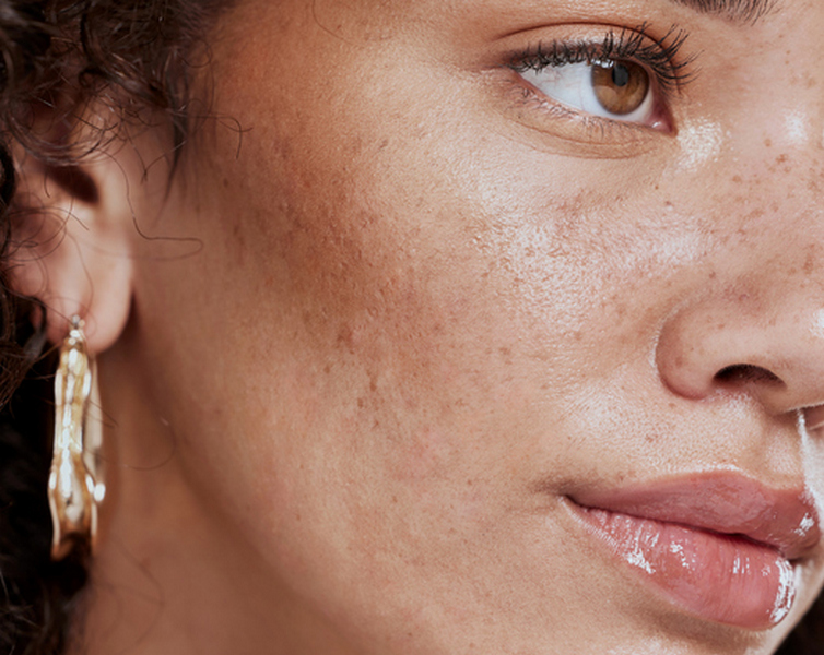 Kako se riješiti hiperpigmentacija