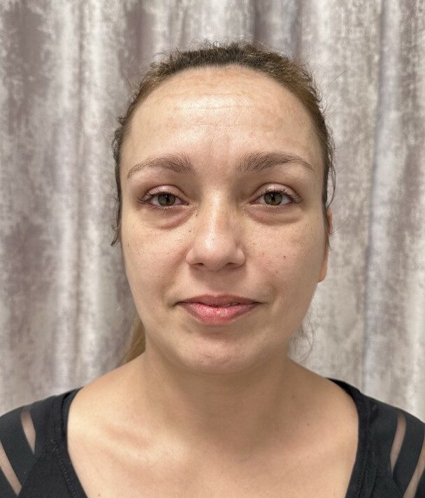 makeover lica u Poliklinici Dermamed