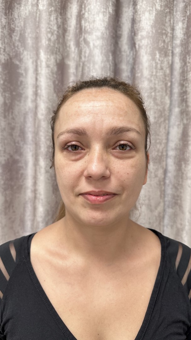 makeover lica u Poliklinici Dermamed