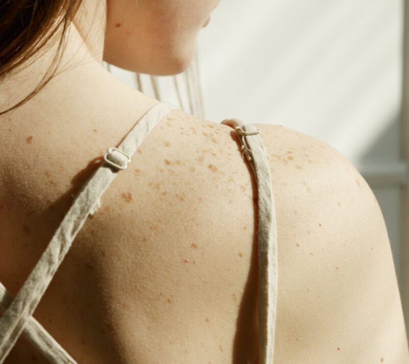 Veliki korak u borbi protiv melanoma: Stiže cjepivo protiv raka kože?