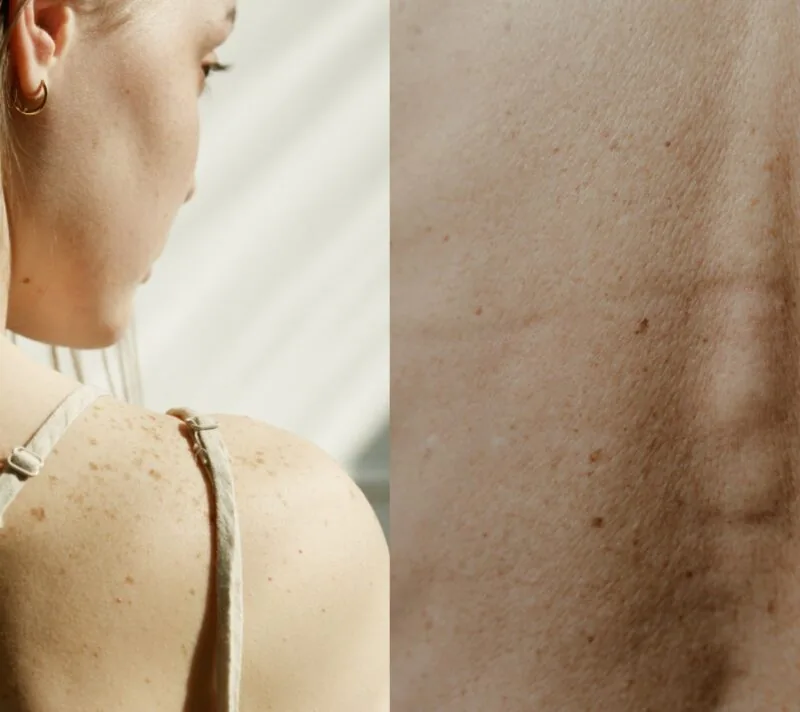 Veliki korak u borbi protiv melanoma: Stiže cjepivo protiv raka kože?