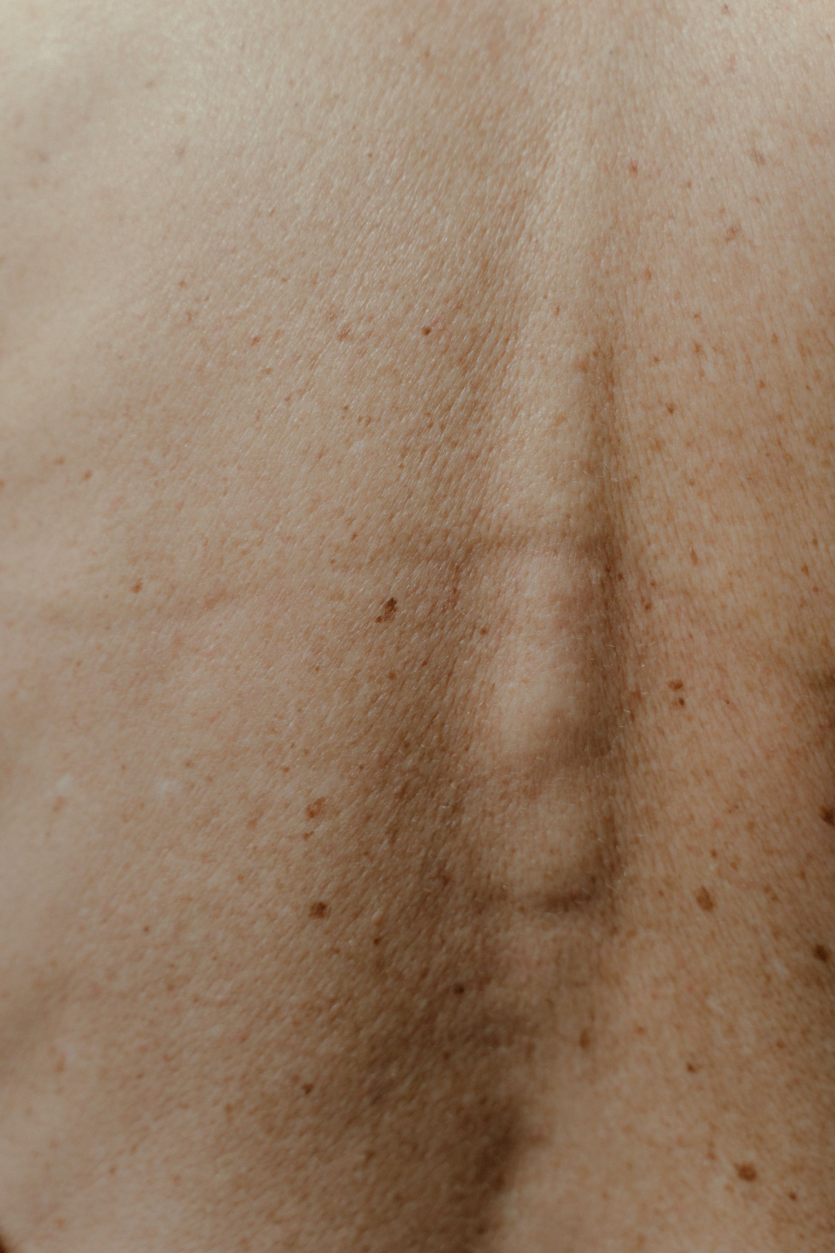 Borba protiv melanoma: Stiže cjepivo protiv raka kože? Borba protiv melanoma: Stiže cjepivo protiv raka kože?